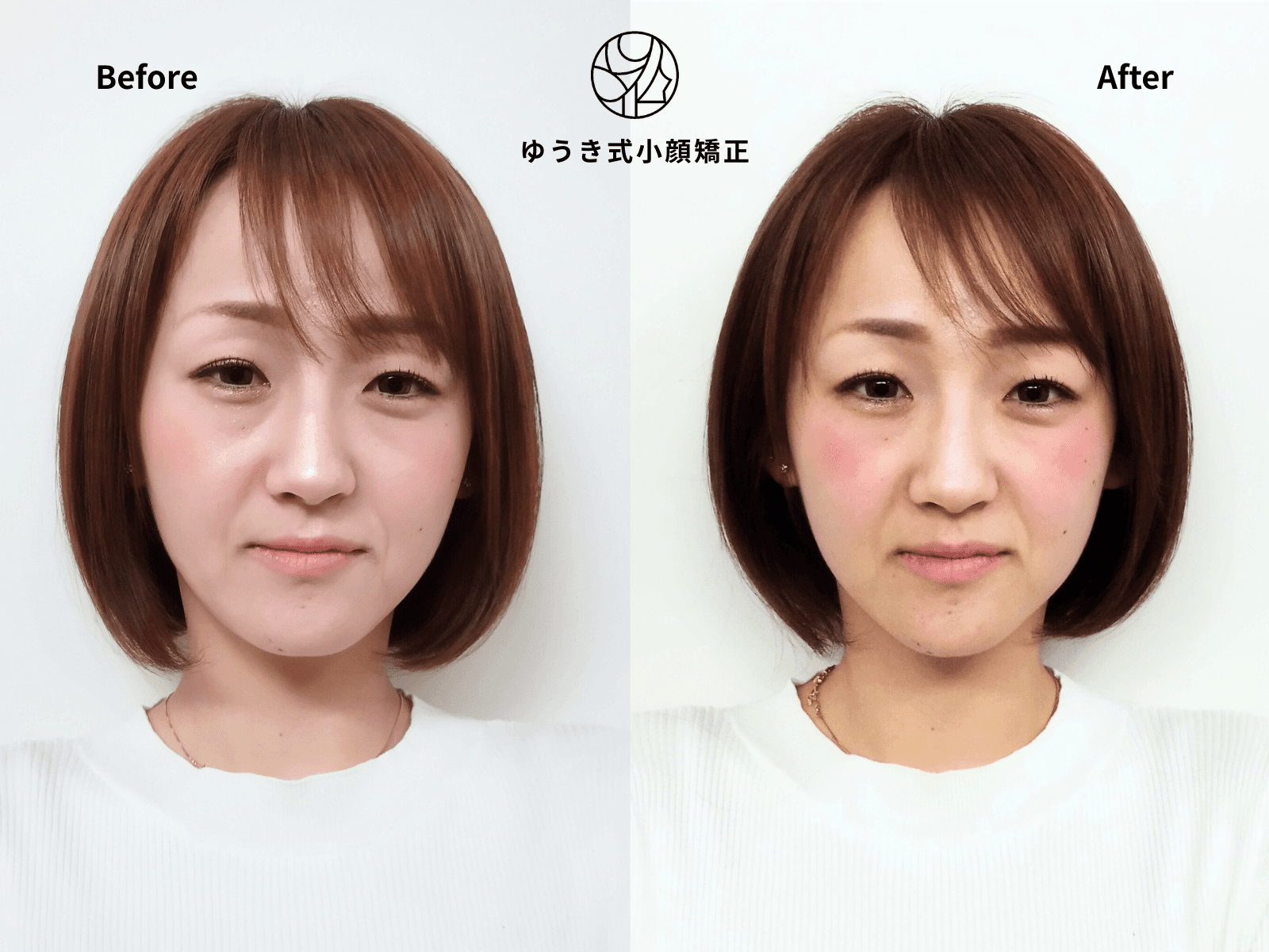 20代女性 出産を機に顔が変わってきた Before/After