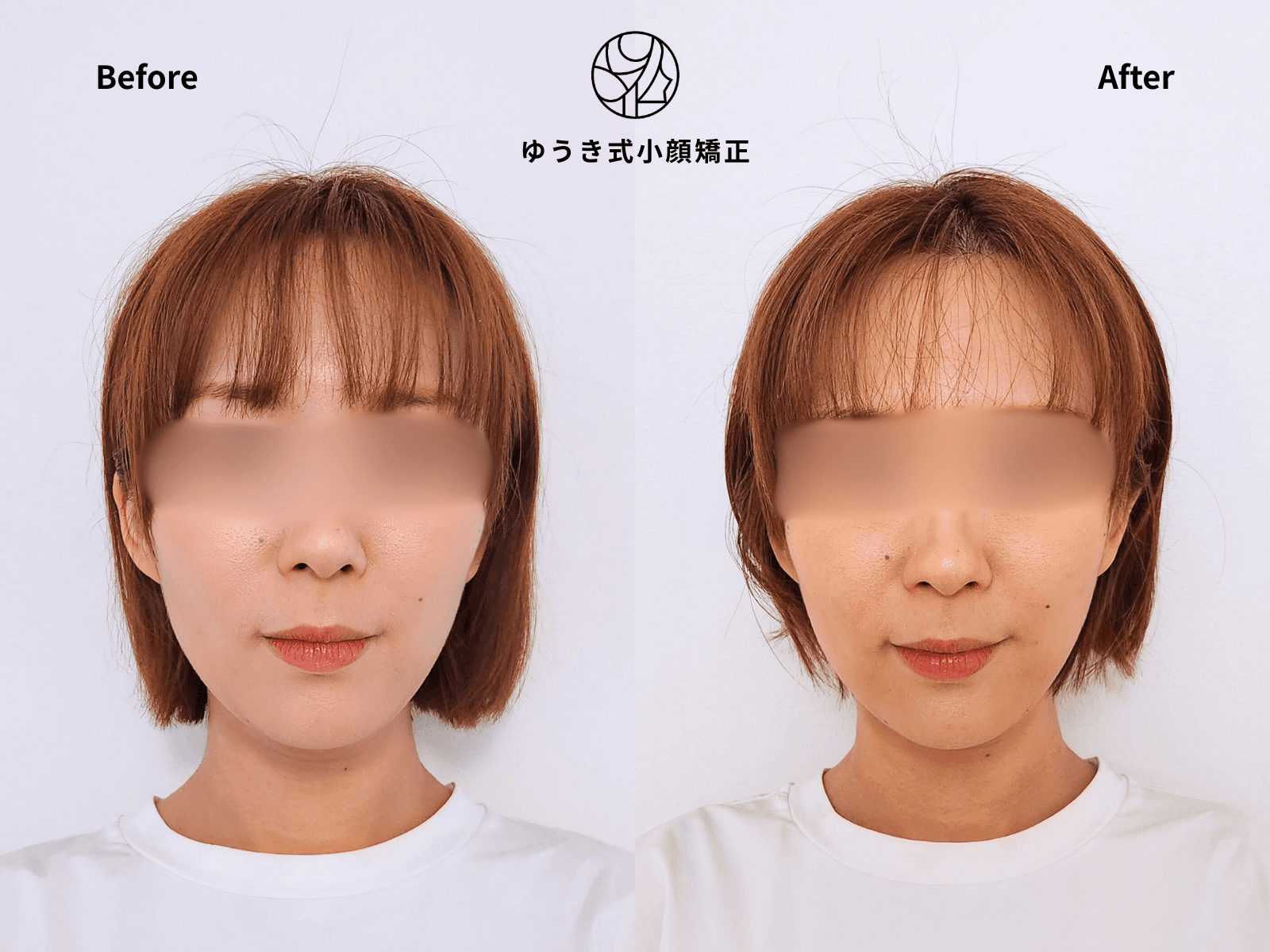 30代女性 顔の歪み、むくまない顔にしたい Before/After
