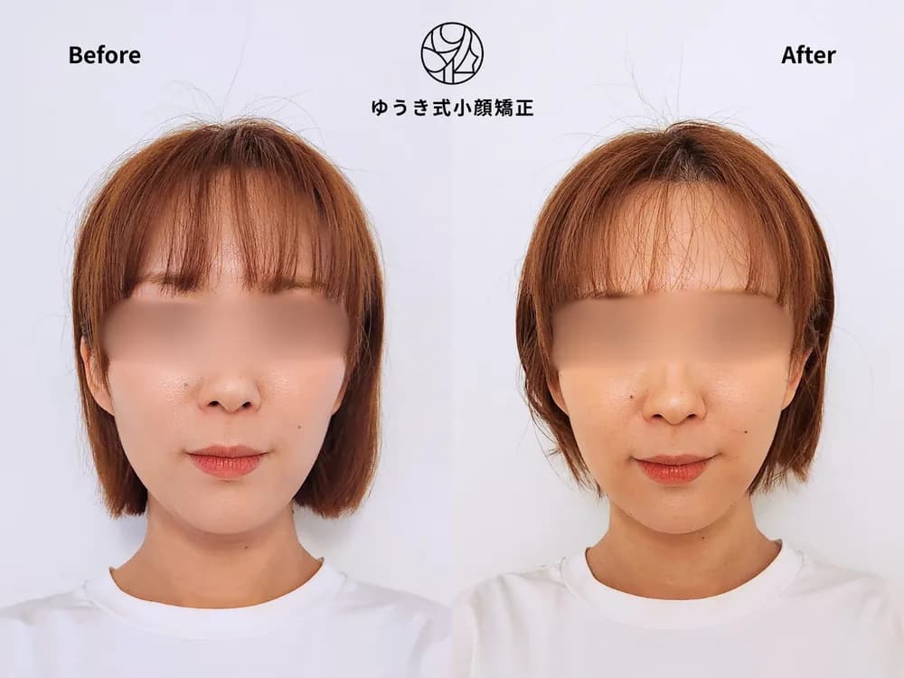 30代女性 顔の歪み、むくまない顔にしたい Before/After