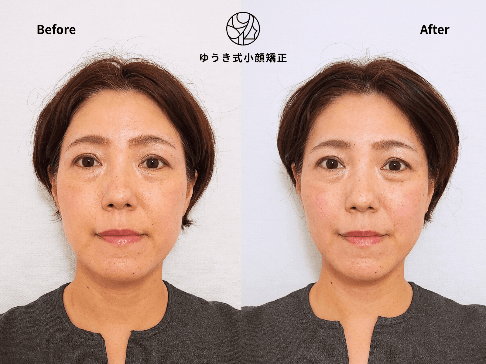 50代女性 たるみと顔が伸びた気がする Before/After