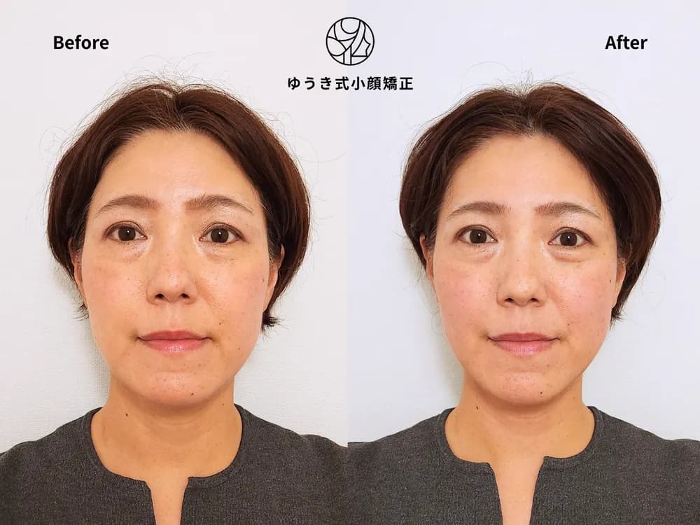 50代女性 たるみと顔が伸びた気がする Before/After