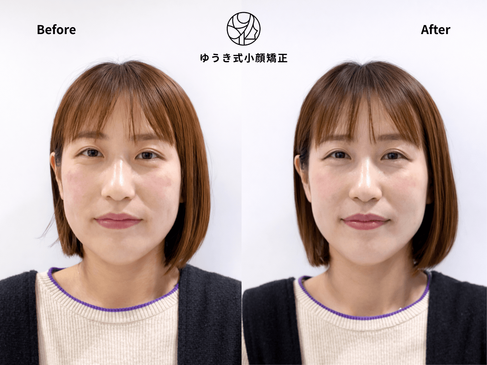 30代女性 顔の左右差・エラ張り Before/After