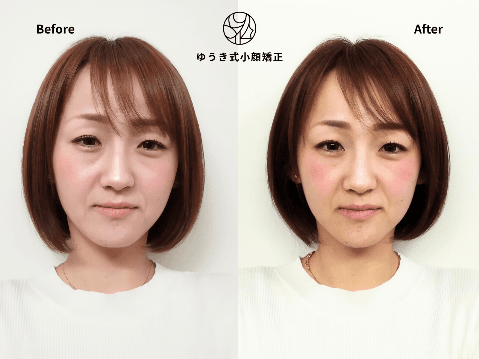 30代女性 丸顔・むくみ Before/After
